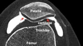 Chondropathierotule3D Arthroscanner [upl. by Wichman]