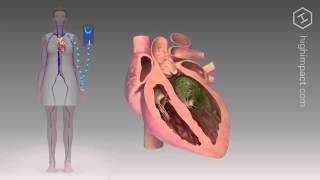 Endocarditis  Proper Antibiotic [upl. by Rosalynd]