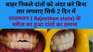 राजस्थान Rajasthan state से आये मरीज़ के बाहर निकले दांतो का इलाज सिर्फ 2 दिन में Smile makeover [upl. by Orfurd]