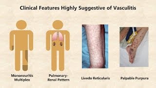 Vasculitis  An Overview [upl. by Naerad599]