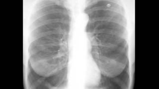 Emphysema on Chest X ray [upl. by Fortin383]