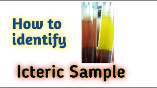 How to identify ictreic sample  icteric serum [upl. by Veradia]