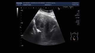 Ultrasound Video showing multiple Fibroids in uterus [upl. by Kylynn763]