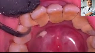 teeth cleaning Tartar removal from teeth [upl. by Georg]