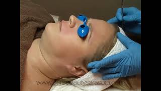 Dermaplane Facial Treatment With Minor Milia Skin Extractions Sarasota Florida [upl. by Aidaas]