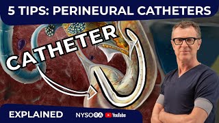 5 TIPS PERINEURAL CATHETERS  Crash course with Dr Hadzic [upl. by Atiuqrehs]