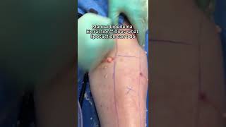 Manual Lipedema Extraction™ [upl. by Seve]