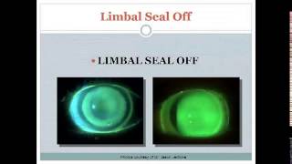 Get All Of Your Scleral Lens Questions Answered [upl. by Rosana188]