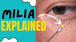 How Do You Remove Milia A Dermatologist Shares Milia Treatment amp Prevention Tips  DERM CHAT [upl. by Warfeld]