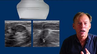 Ultrasound of the Breast  part 2 [upl. by Riva]