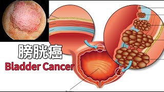 Your Gut Bacteria Might Be Linked to Bladder Cancer [upl. by Anaer877]