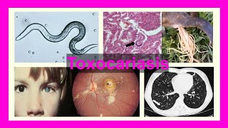 toxocariasis [upl. by Eillil132]