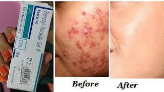 इससे होंगे पिंपल्स खत्म  Clear Acne Pimples once and for all  best solution for acne RabiaSkincare [upl. by Bartlett84]