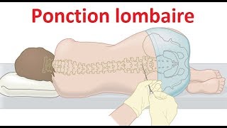 Ponction lombaire Examen du liquide céphalorachidien LCR [upl. by Nanyk]