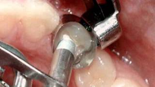 Restorations Amalgam Fillings [upl. by Anirtik]