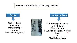 Chest XRay Pulmonary Cavitary Lesions  Pediatrics [upl. by Carlson]