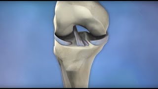 ACL Injury Prevention  Mayo Clinic [upl. by Danila45]