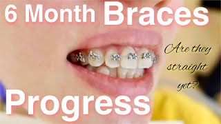 6 months braces progress in less than 2 minutes Video and phone time lapse [upl. by Ainigriv908]