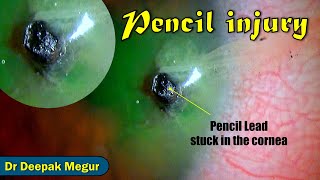 Pencil Injury to the eye  Pencil Lead Stuck inside Tips to remove the FB  Dr Deepak Megur [upl. by Genny363]