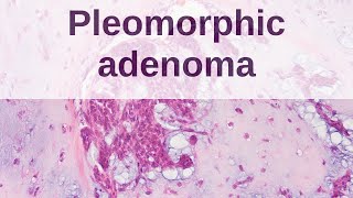 Pleomorphic Adenoma of Salivary Gland [upl. by Jenkel307]