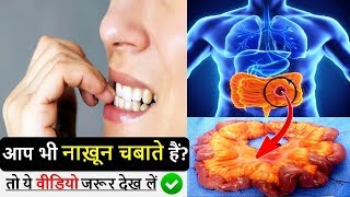 नाखून चबाने से होती है ये गंभीर बीमारियां हो जाएं अलर्ट Top 6 Nail Biting Side Effects [upl. by Correy]