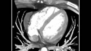 Cardiac Pericardial Cyst 2 of 2 [upl. by Grew]