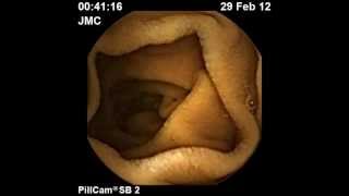 Cápsula Endoscópica PillCam  Estômago e Intestino Delgado [upl. by Lemuelah]