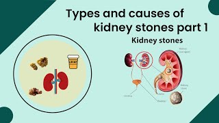 Types and causes of kidney stones part 1 Kidney stone symptoms Kidney stone treatment Kidney diet [upl. by Brie]