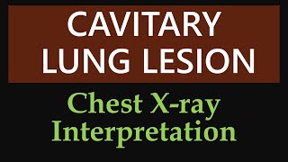 Cavitary Lung Lesion  Chest Xray Interpretation [upl. by Ervin384]