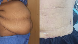 টামি টাক সার্জারীর রেজাল্ট। Tummy Tuck Surgery Result in Bangladesh [upl. by Gulgee]