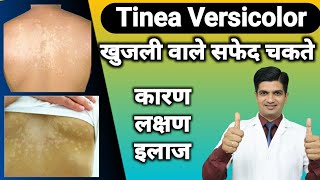 Skin की बीमारी  Tinea versicolor cause treatment [upl. by Asilav]