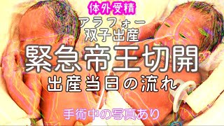 【双子出産・緊急帝王切開】常位胎盤早期剝離NICU双子出産レポ高齢出産初産36週 [upl. by Paderna]