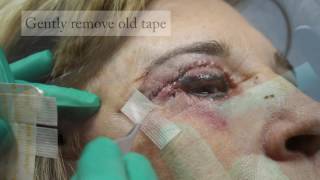 Blepharoplasty PostOp Eyelid Taping Instructions  Dr Kutty [upl. by Annais]