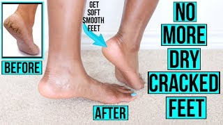 How to Get Rid of Dry Cracked Feet FAST amp NATURALLY  AT HOME Remedies amp MORE [upl. by Nezam]