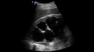 Hydronephrosis Ultrasound Case [upl. by Marvel]