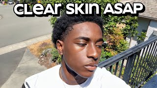 how to get clear skin for guys asap [upl. by Rena]