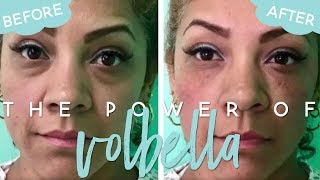 Volbella Under Eyes  Petro Facial Plastic Surgery amp MedSpa [upl. by Nylatsirk367]