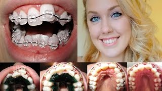 Braces Time Lapse Beautiful Transformation Ashley Craig [upl. by Vivianne3]