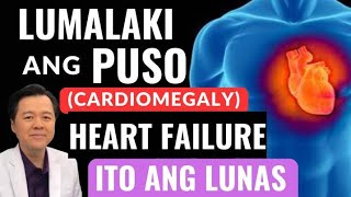 Lumalaki ang Puso Cardiomegaly Heart Failure Ito ang Lunas By Doc Willie Ong [upl. by Farah]