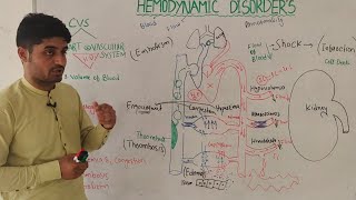 overview of hemodynamic disorders in hindi  hemorrhageshock infarction edema etc  by Dr aqib [upl. by Fleming]