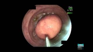 Colonic lipoma [upl. by Aicilat473]