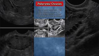 Polycystic Ovaries PCOs 💯❤️ polycysticovarysyndrome ovary pregnancy medical ultrasound health [upl. by Gable499]