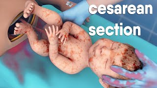 A cesarean section  known as a Csection  is a surgery to deliver a baby via the abdomen [upl. by Oni]