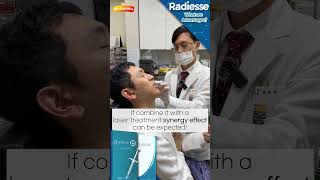 Radiesse Non  surgical face volume augmentation method [upl. by Tenner]