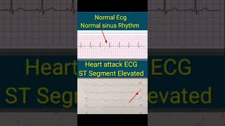 हार्ट अटैक को पहचाने HEART ATTACK ECG vs NORMAL ECG The SHOCKING Differenceshorts [upl. by Cliff]