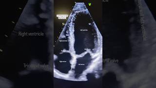 Heart Echocardiogram 🫀echocardiography ultrasound shorts heart [upl. by Yrovi611]