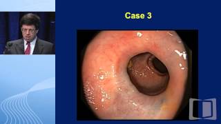 Can You Solve the Case Unknowns from Colonoscopies of Ulcerative Colitis Patients [upl. by Bonine]