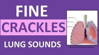 Crackles Fine Lung Sounds  Crackles and Rales Breath Sounds Abnormal [upl. by Alial]