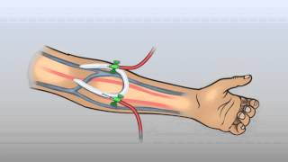 ARTERIOVENOUS GRAFT [upl. by Ran]