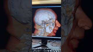 Ct scan video  The Power of Toshiba Aquilion CX 128 Slice CT Scanner viral highlights trending [upl. by Mesics84]